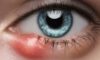 Eye Styes: Causes Explained and Effective Home Remedies